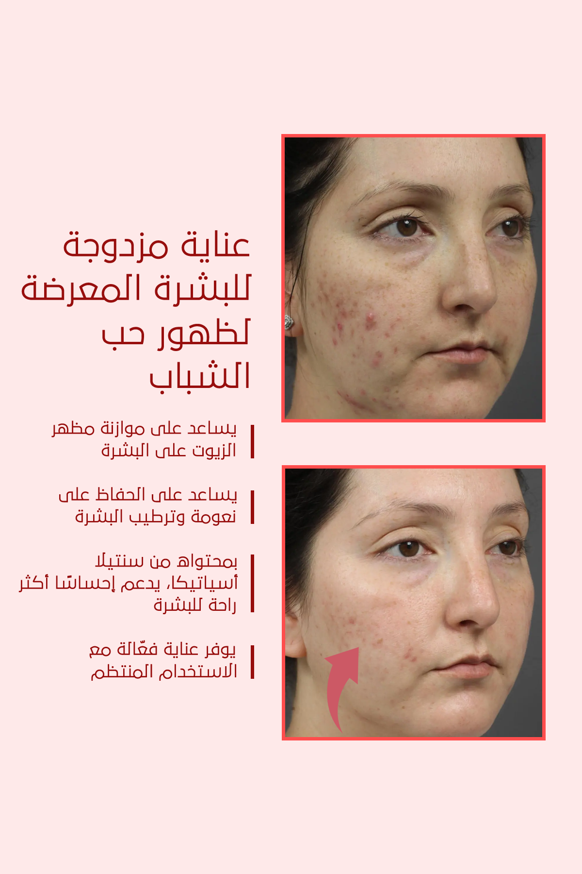 تأثير مثالي لحبّ الشباب والبثور – FACEUPSKIN® Acne Cream ‏40 مل