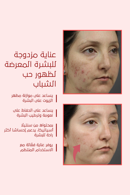 تأثير مثالي لحبّ الشباب والبثور – FACEUPSKIN® Acne Cream ‏40 مل
