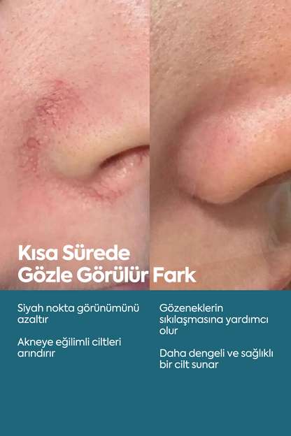 Siyah Nokta ve Akne Düşmanı - مصل مضاد للرؤوس السوداء وحب الشباب 50 مل