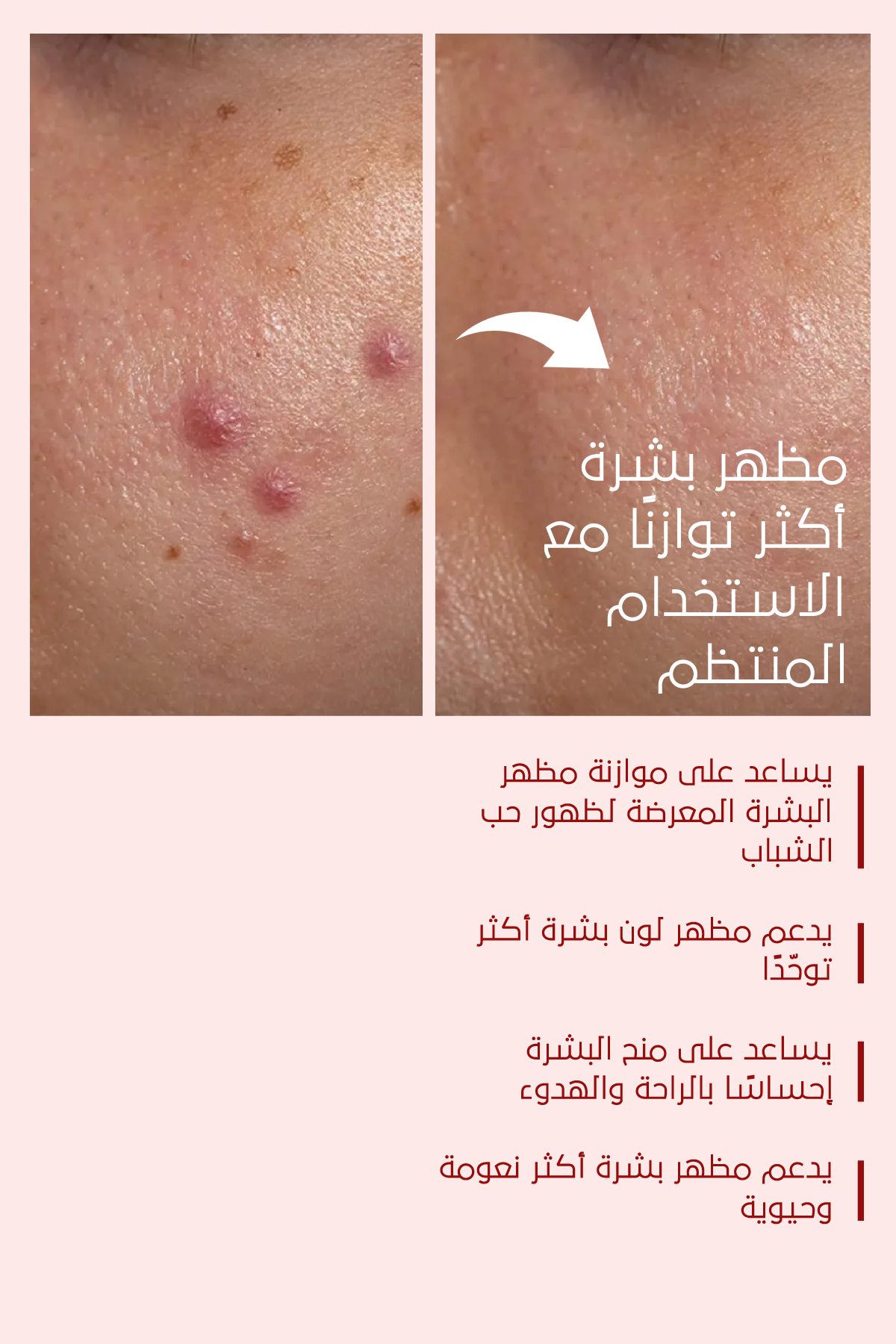 تأثير مثالي لحبّ الشباب والبثور – FACEUPSKIN® Acne Cream ‏40 مل