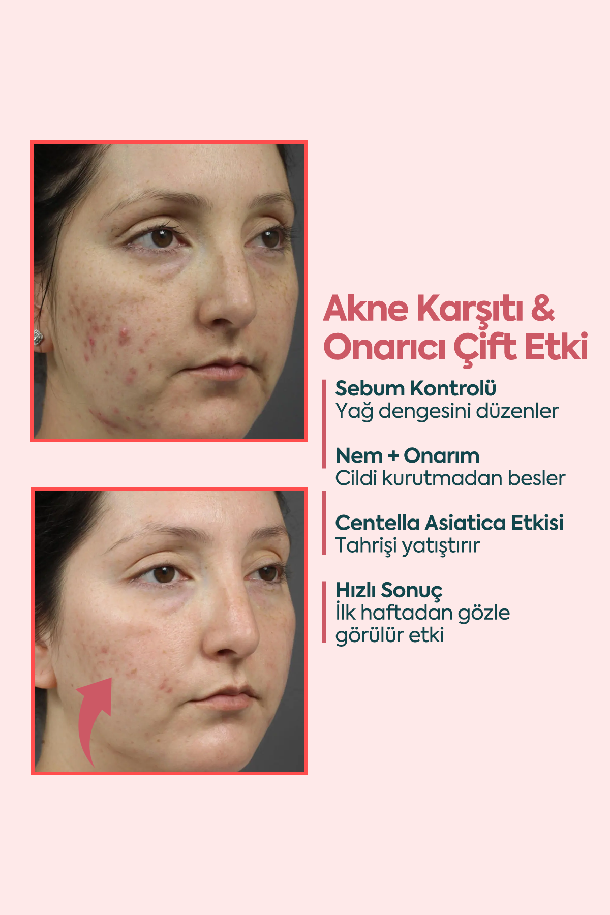 Akne ve Sivilceler için Mükemmel Etki - كريم حب الشباب FACEUPSKIN® 40 مل