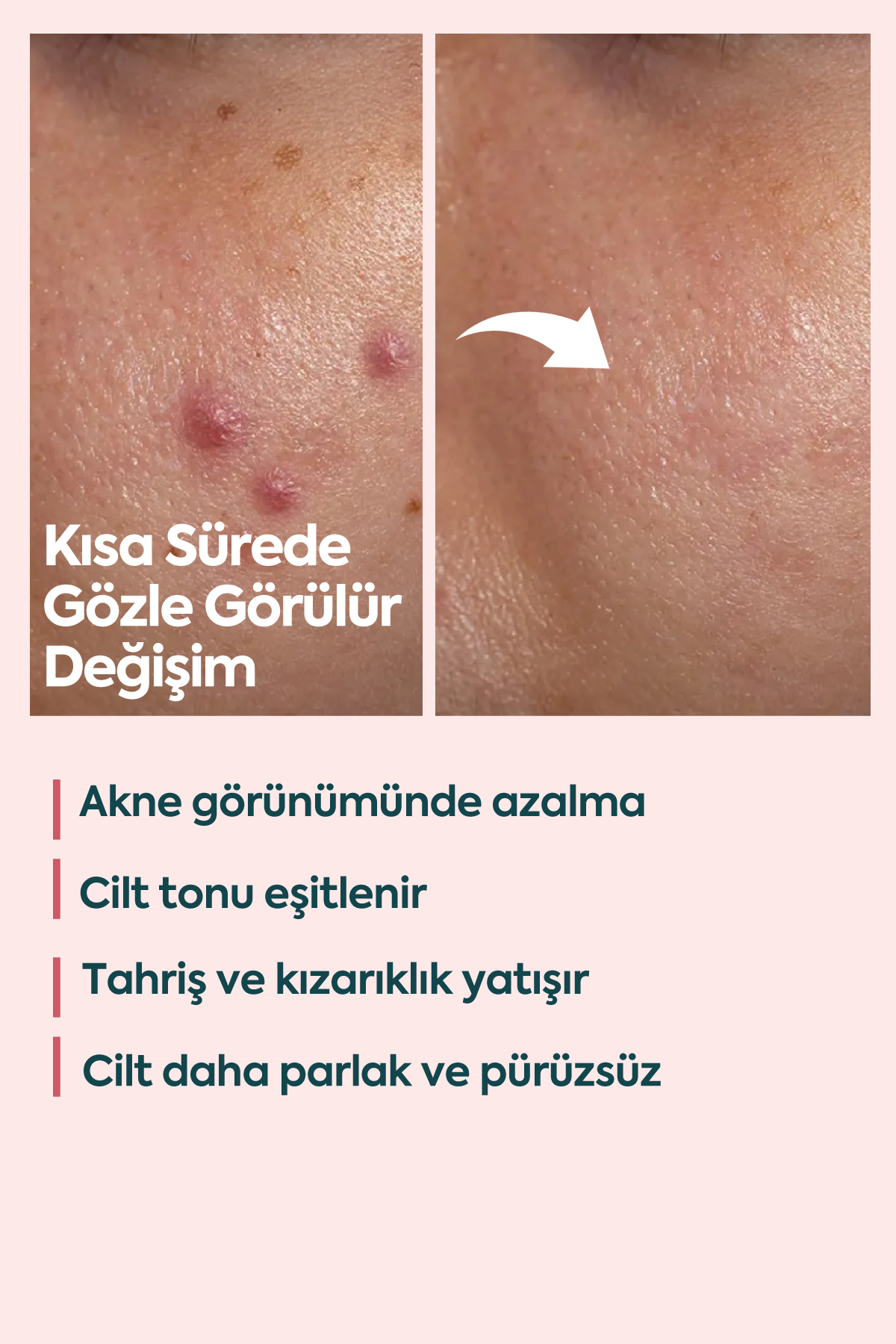 Akne ve Sivilceler için Mükemmel Etki - كريم حب الشباب FACEUPSKIN® 40 مل
